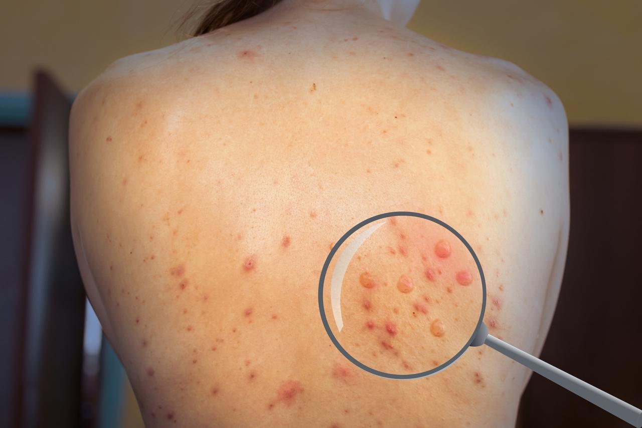 Infecção pelo vírus da varíola dos macacos (monkeypox virus) na pele de uma mulher; sintoma é característico da doença Foto: Shutterstock